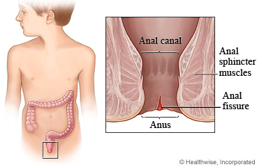 Anal fissure ointment prescribed