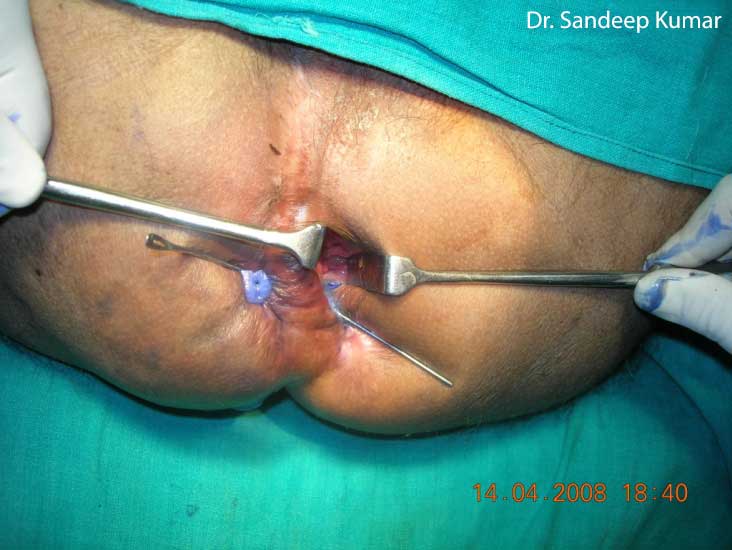 Opinion Anal fissure pain when walking Anal fissure pain when walking